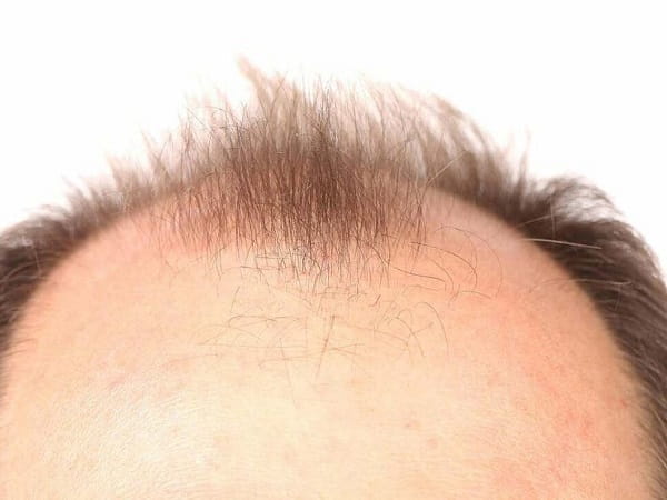 Nằm mơ thấy hói đầu là điềm gì, lành hay dữ?